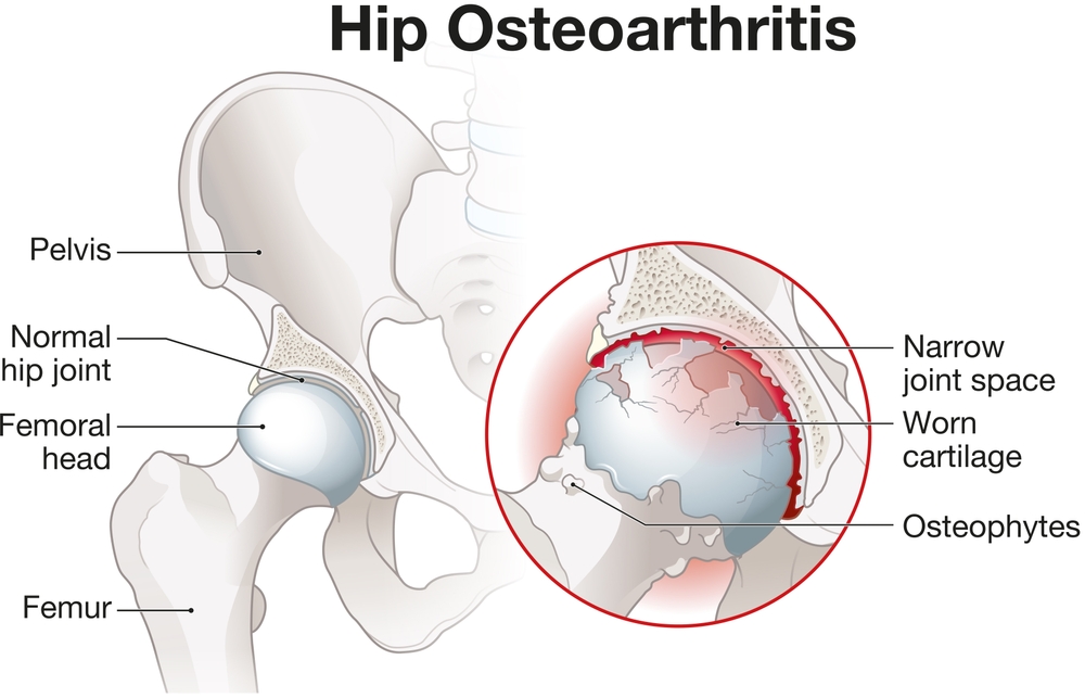 Endoproteza kolka osteoartritis