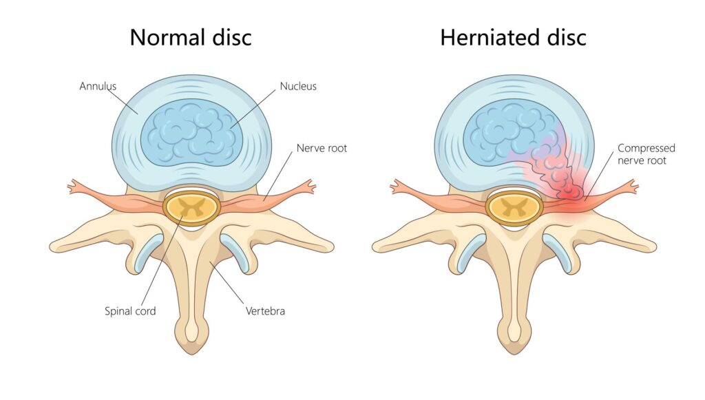 Hernija diska anatomija