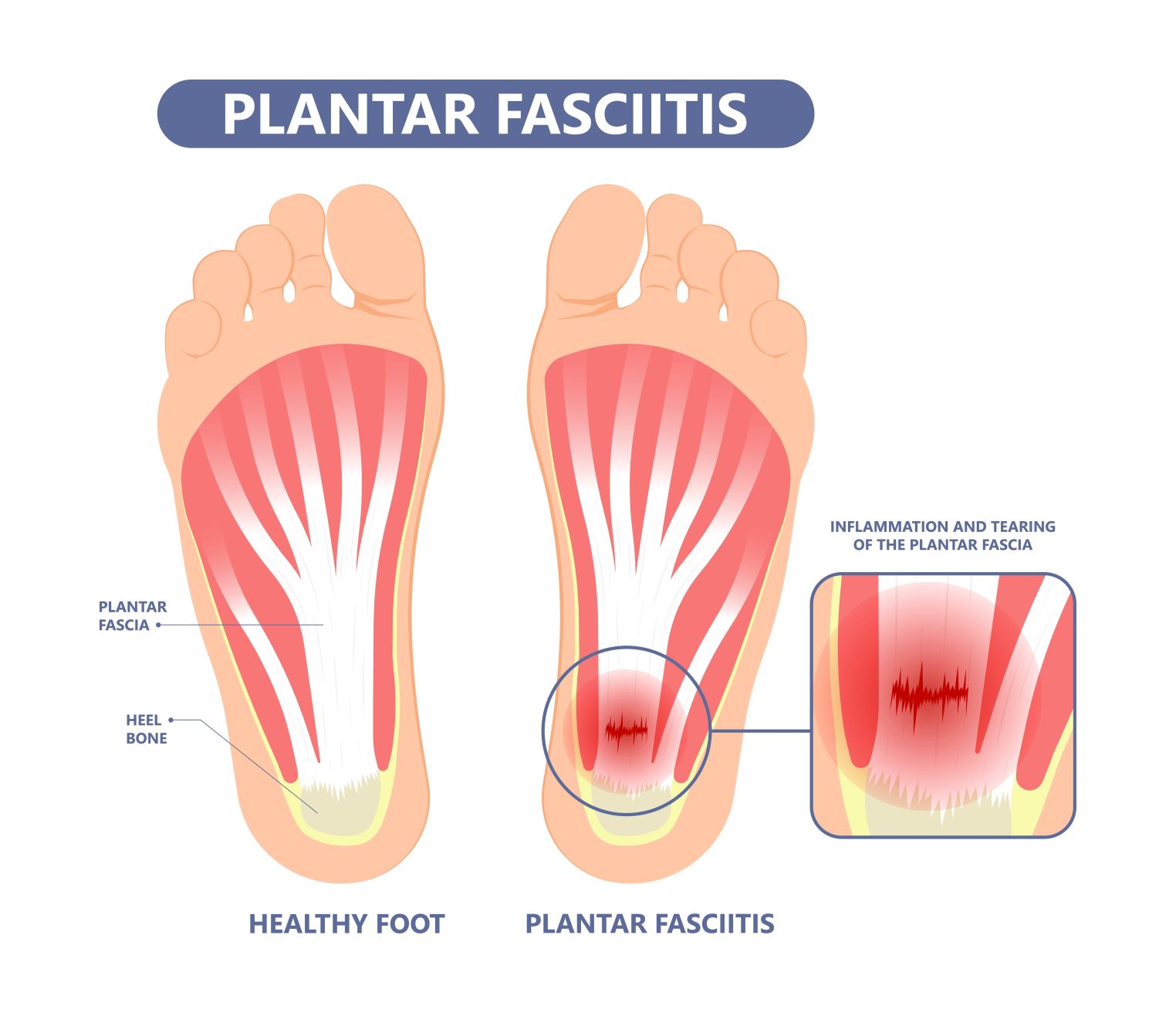 Plantarni fasciitis anatomija