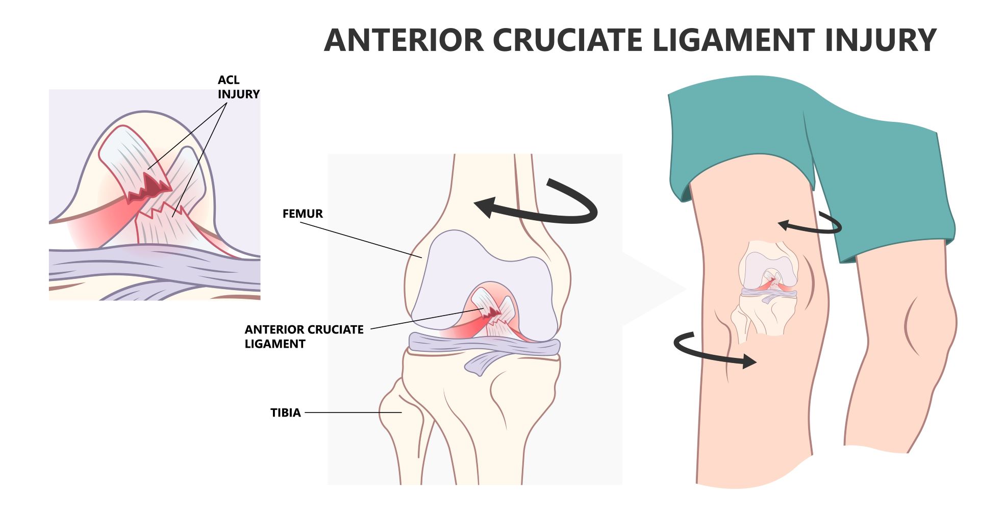 Ruptura ACL mehanizem
