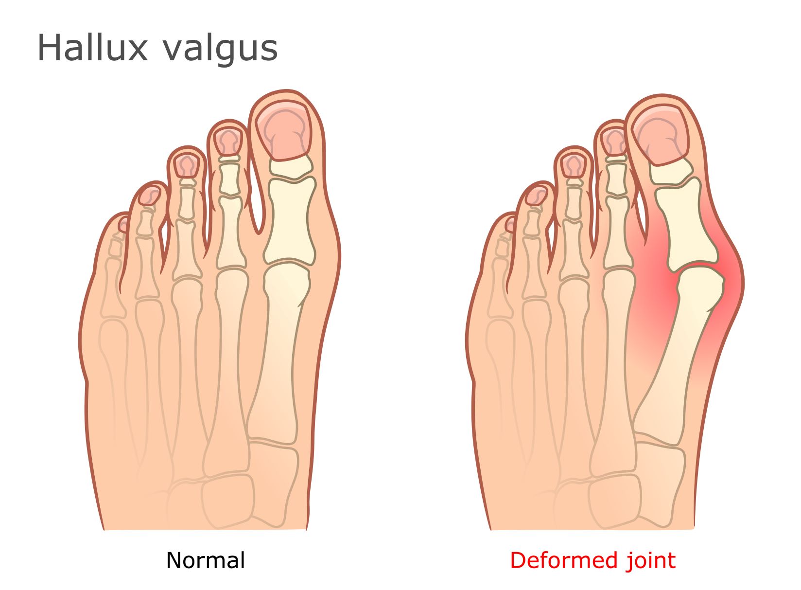 Hallux valgus anatomija