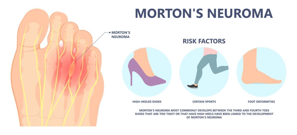Mortonov nevrom anatomija