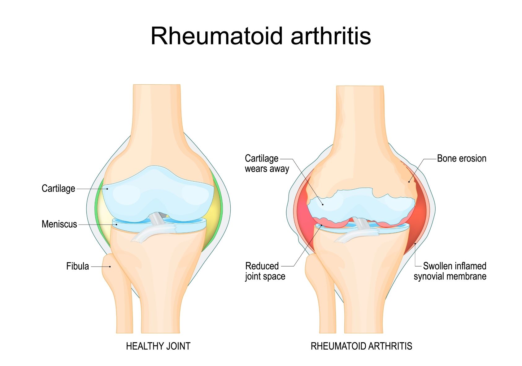 Revmatoidni artritis anatomija