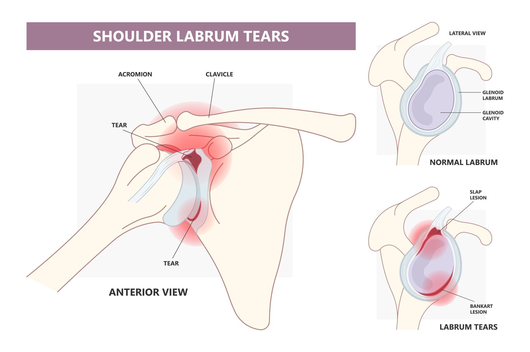 SLAP lezija anatomija