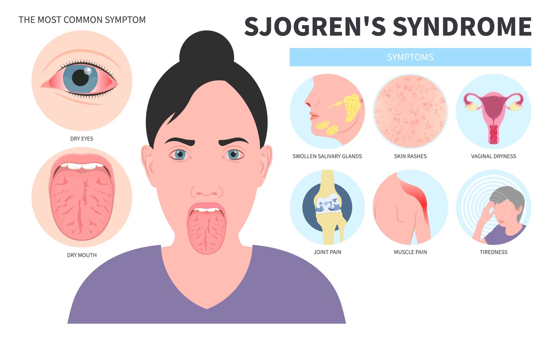 Sjogrenov sindrom simptomi